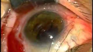 Band Keratopathy Surgery Video OSREF [upl. by Rothmuller]