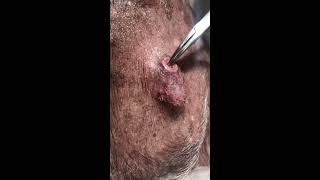 Bot fly larva removal from a 9 year old canine [upl. by Emlyn]