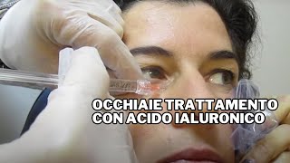 Occhiaie Trattamento con Acido Ialuronico [upl. by Nahs]