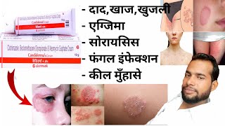 Candiderma Plus Cream  Candiderma Plus Cream Uses in Hindi  त्वचा का संक्रमण [upl. by Ynez]