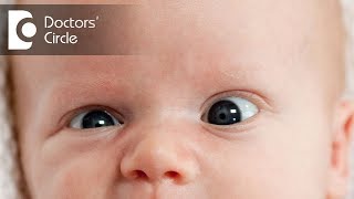 Causes amp management of Strabismus  Dr Sriram Ramalingam [upl. by Maren612]