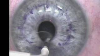 Conductive Keratoplasty [upl. by Chlori]