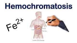 Hemochromatosis  USMLE COMLEX NCLEX [upl. by Ahsyen]