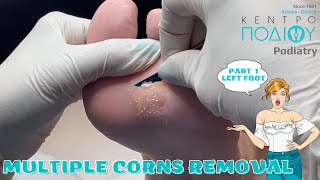 Corns Removal P1 feet κεντροποδιου foot podologos podiatrist corn footcare podiatry callus [upl. by Wessling]