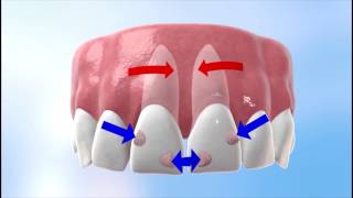 Discover how Invisalign works [upl. by Abixah]