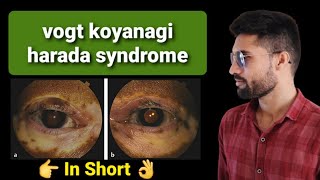 Vogt Koyanagi Harada VKH Syndrome lecture [upl. by Yeung]