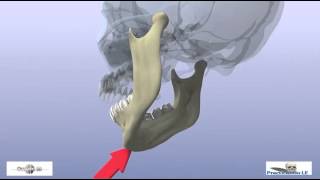 fractures of the mandibular condyle [upl. by Nageam]