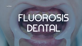 FLUOROSIS DENTAL  DENTAL CALIFORNIA [upl. by Notanhoj]