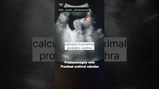 Prostatomegaly benign prostatuc hypertrophy urethral calculus drwasiultrasound [upl. by Incrocci509]