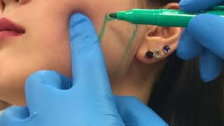 Treating enlarged masseter muscles with Botox by Dr Shaun Patel [upl. by Nnaasil293]