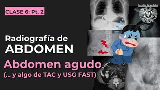 8 Posición de abdomen agudo por lesiones traumatológicas [upl. by Trahurn224]