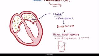 Fibrilación Auricular [upl. by Henley]