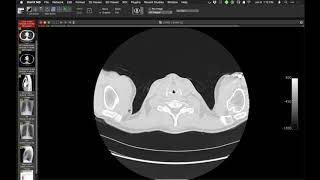 STR Cardiothoracic Case Webinar 192020 [upl. by Korie]