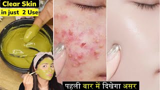 सिर्फ 2 दिन में करे साफ़Whiteheads दाने Oily Skin Bumps PimplesGot Clear Oil Free Skin in 2 Use [upl. by Lochner31]