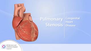 Heart Conditions – Pulmonary Stenosis [upl. by Lhadnek892]