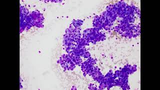 Parotid gland Acinic cell carcinoma Airdried smear [upl. by Tahpos662]