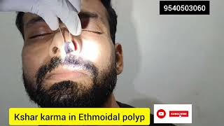 Ethmoidal polyp kshar removal [upl. by Solange]