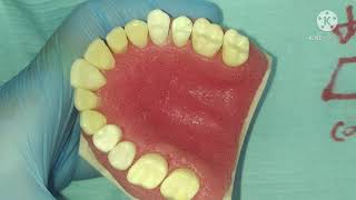 class 2 cavity preparation for amalgam restoration  upper premolar reversal line عربي  طب أسنان [upl. by Atiniv]