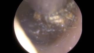 Endoscopic Ear Wax Removal of Blocked Ear Wax by Mr Neel Raithatha  Ep 304 [upl. by Mensch]