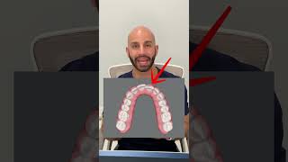 Quick Invisalign Case Study 2024 [upl. by Adnirual497]