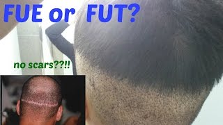 FUE vs FUT Which Hair Transplant Method is Better [upl. by Essilevi]