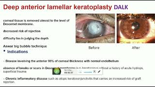 keratoplasty part 2 [upl. by Aer]