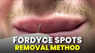 How to remove Fordyce Spots  Fordyce Spots Removal with NEEDLE METHOD Tutorial [upl. by Faletti]