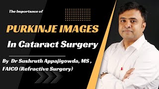 The Importance of Purkinje Images in Cataract Surgery [upl. by Teiluj]