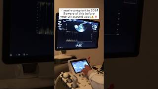 Best Pregnancy Scan Gift❤️🎁 ultrasoundappointment pregnancy pregnant baby [upl. by Flin984]