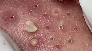 Nasa SPA 03 satisfying cyst relaxing blackhead pimple acne [upl. by Aneger]