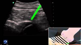 How To Hip UltrasoundGuided Injection of the Proximal Hamstring 3D Video [upl. by Yblek]