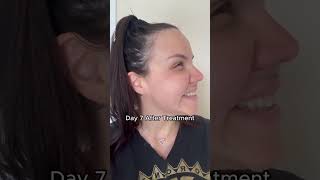 Botox Crows Feet Angry 11s amp Botox Forehead Lines  Botox Full Face Transformation [upl. by Yenttihw412]