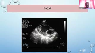 Echocardiography in Heart Failure [upl. by Airtened]