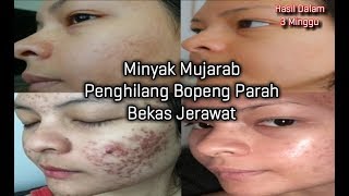 ACNE STORY INCES BOLANGPENGHILANG BOPENG JERAWAT ALAMI [upl. by Einahpehs564]