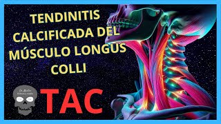 TENDINITIS Calcificada del Músculo LONGUS COLLI en TOMOGRAFÍA [upl. by Reed340]