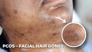 HOW TO WAX YOUR CHIN HAIR AT HOME  DIY Sugar Wax Hair Removal Hack [upl. by Eiramanin611]