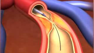 Percutaneous coronary Intervention stenting [upl. by Aivataj386]