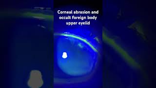 Corneal abrasion and occult foreign body under the upper eyelid protectingsight ophthalmology [upl. by Emmalee945]