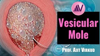 Vesicular Mole Part 1 [upl. by Rimidalv]