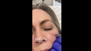 Tear trough filler  before during amp after [upl. by Otsirc]