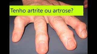 Como diferenciar artrose de artrite nas mãos guia simples e completo [upl. by Ellinger]