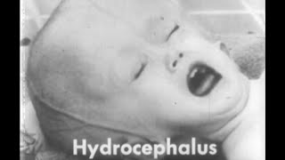 Hydrocephalus waterbrain 1950s Medical Teaching film on the quotFeeblemindedquot [upl. by Rhpotsirhc]