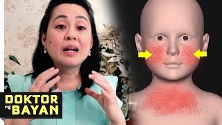 ECZEMA Tamang Gamutan  Doc Liza RamosoOng Health Tips 10b [upl. by Dasi]