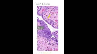 Exam slides squamous epithelial lesions set 21 Dr GSS SRM MCH RC [upl. by Deehsar]