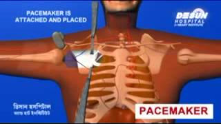 Pacemaker price in Desun Hospital Kolkata [upl. by Votaw]