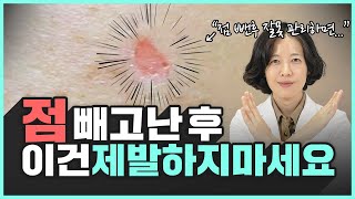 의사가 알려주는 점빼고 흉터 색소침착 남지 않는 후관리 방법  흉터 색소침착 [upl. by Rab]