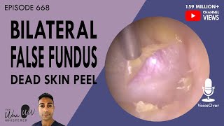 668  Bilateral False Fundus Dead Skin Peel [upl. by Ocirema]