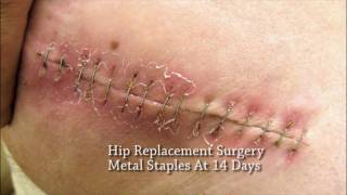 A More Patient Centric Solution To Metal Skin Staples in Surgery Absorbable Skin Staples [upl. by Maram]