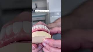 Allon4 dental implants [upl. by Sisile858]