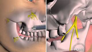 мандибулярная анестезия по вазирани акинозиmandibular anesthesia for Vazirani akinozi [upl. by Teirtza]